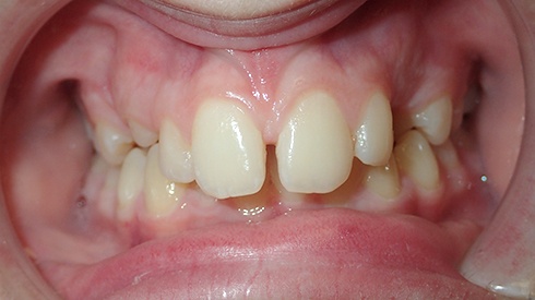 Patient's smile with uneven spacing deep overbite and excess overjet