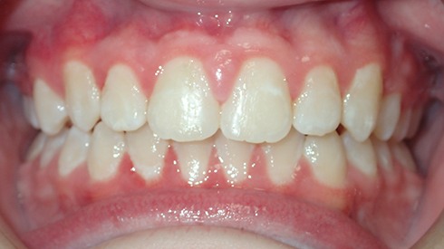 Smile after treatment for spacing issues deep overbite and excess overjet