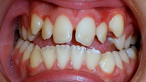 Closeup of smile with unevenly spaced teeth open bite and narrow maxilla