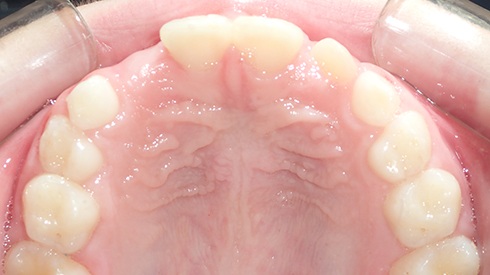 Inside of mouth after treatment for anterior and posterior crossbite retracted and narrow upper jaw and airway restriction