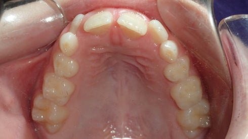 Closeup of smile with narrow upper jaw and airway restriction