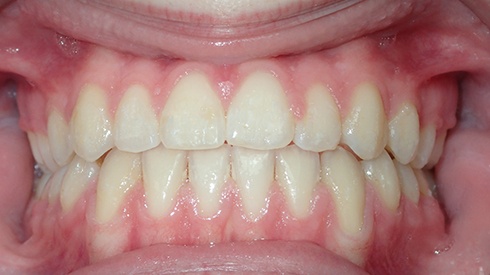 Closeup of smile after underbite and crossbite are addressed