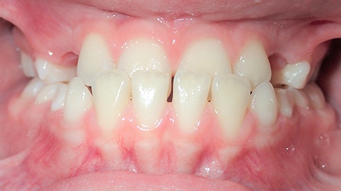 Closeup of smile with underbite and crossbite