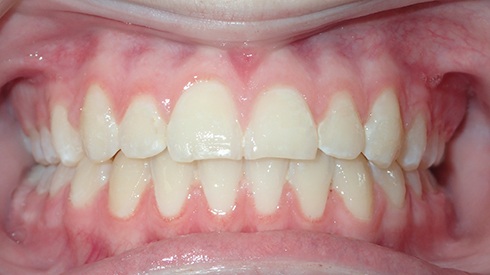 Closeup of aligned smile after full braces