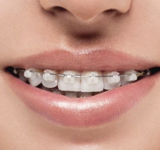 Closeup of smile with clear and ceramic bracket and wire braces