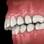 Illustration of crooked teeth
