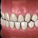 Illustration of gapped teeth
