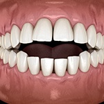 Illustration of an open bite