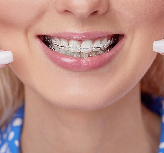 Closeup of woman in blue polka dot dress pointing to her clear braces