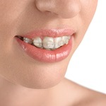 Closeup of woman’s mouth with clear braces on top arch