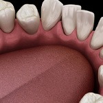 Illustration of gapped teeth