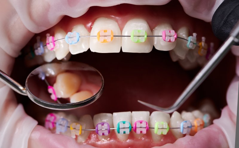 Using Rubber bans with Braces